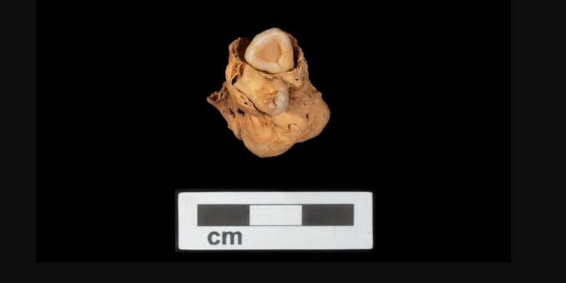 Найстаріша у світі. У давньоєгипетському похованні виявили рідкісну пухлину із зубами